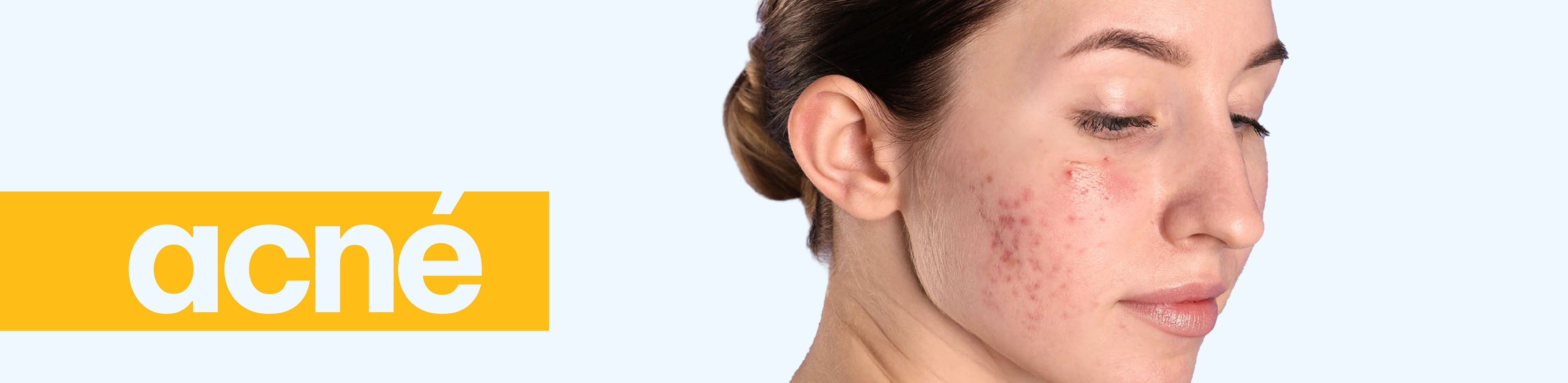 ACNE_0a5fb01f-1ec5-47f1-96fe-dac09b9e2c08.jpg