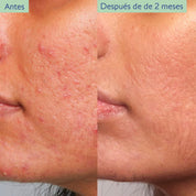 Caudalie Vinopure Serum Tratamiento para el Acné con Ácido Salicílico 30ml
